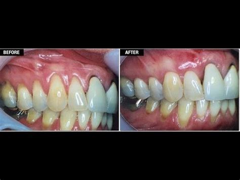 When gingivitis progresses to pyorrhea, the. Can You Reverse Receding Gum Line From Getting Worse ...