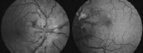 Bilateral Optic Disc Swelling With Hemorrages And Macular Star