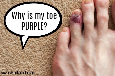 Why Is My Toe Purple Rocky Mountain Foot And Ankle Diabetes How To