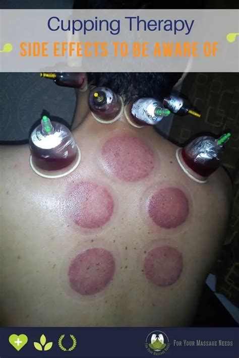 Cupping Therapy Side Effects For Your Massage Needs