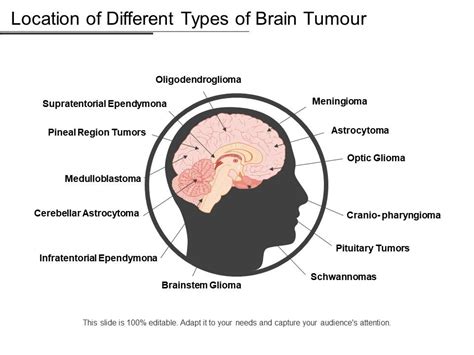 Location Of Different Types Of Brain Tumor Powerpoint Presentation