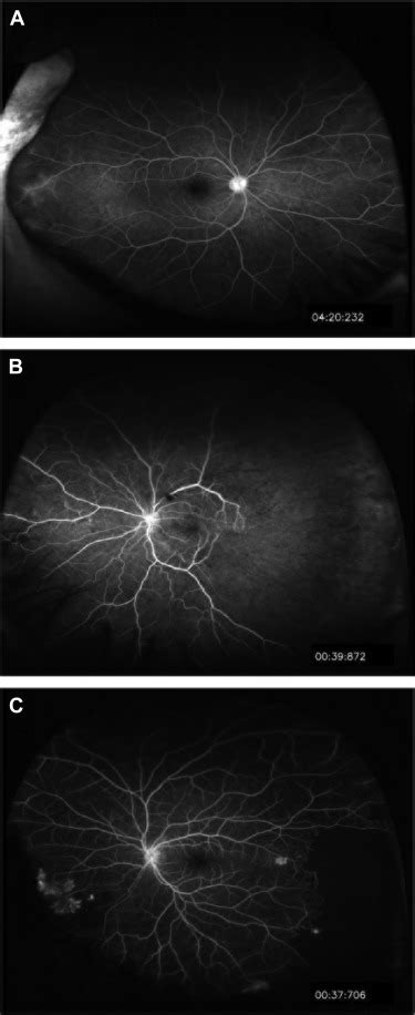 Peripheral Findings And Retinal Vascular Leakage On Ultra Widefield