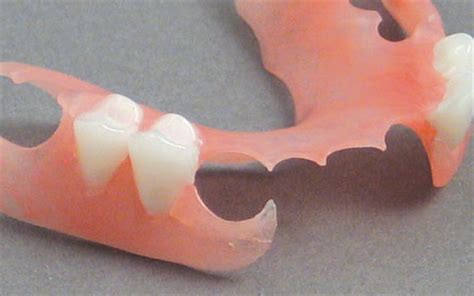 Dental Labs For Dentures In Arizona Conventional Full And Partial