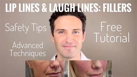 Fillers Upper Lip Lines Smile Lines And Accordion Lines Part 2 Of 3