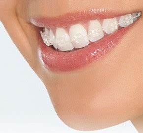 What Are Ceramic Braces Smile Solutions Article