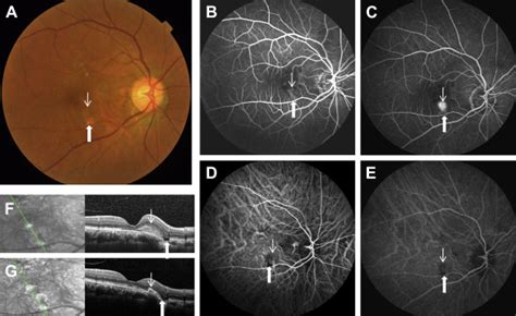 Focal Choroidal Excavation Fce Eyewiki