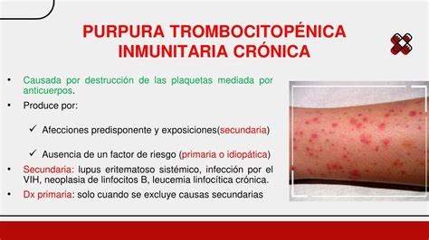 Púrpura Trombocitopénica Inmunitaria Crónica Esmeralda Azucena