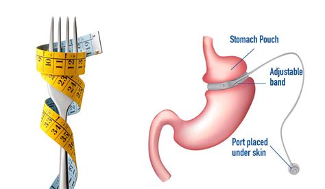 Lap Band Surgery Cost In India Gastric Band Surgery Top Hospitals