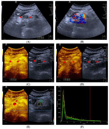 Diagnostics Free Full Text Prediction Of Pathological Grades Of