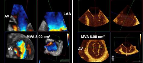Calculation Of Mitral Valve Area A Mpr Of 3d Multi Beat Cfd Download Scientific Diagram