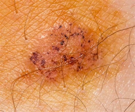 Ringworm Skin Lesions