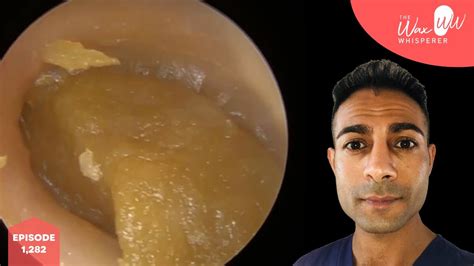 1282 Very Impacted Ear Wax Removal Youtube