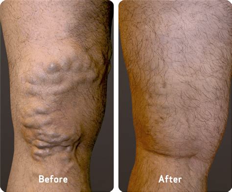 Varicose Veins Causes Symptoms And Treatment