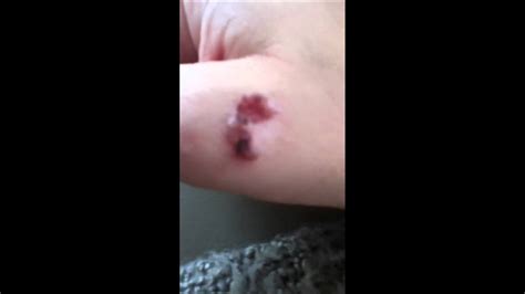 Spider Bite Infected Youtube