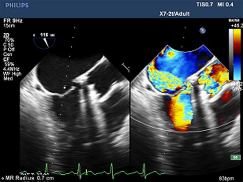 Rare Cause Of New Mitral Regurgitation After Aortic Valve Replacement