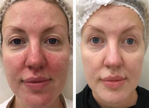 Ipl Before And After Rosacea