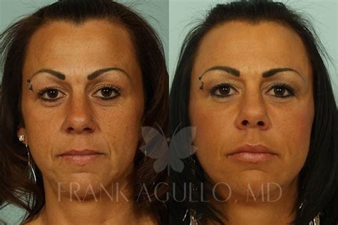 Before And After Photos Fat Injections 4 Frank Agullo Md