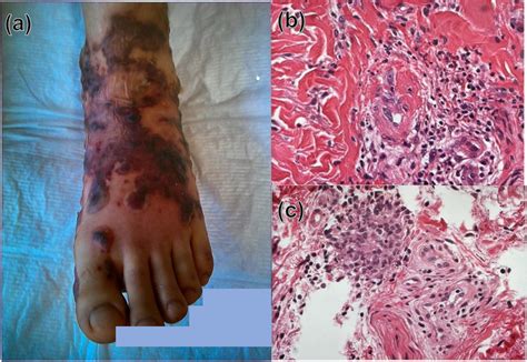 A Skin Lesion Presenting As Purpuric Bullous Rash In Lower Limbs And