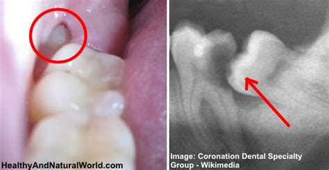 Wisdom Tooth Pain Relief The Top 10 Home Remedies