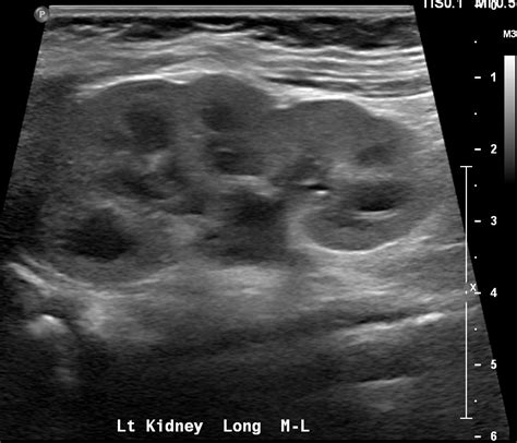 Ultrasound Pediatric Renal Radiology Template Reports