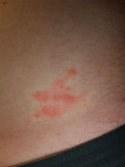 This Kind Of Bumpy Rash Has Shown Up On My Stomach Just Above My