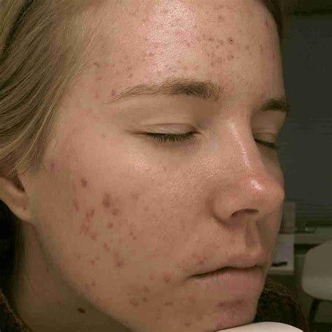 Acne En Littekens Behandelingen Met Laser Skin Kliniek