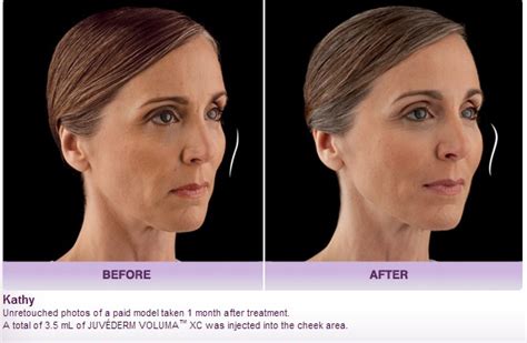 Juvéderm Voluma Dermal Filler Before After Photos Palm Springs Ca