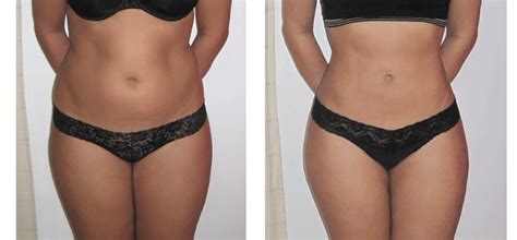 Flank Liposuction Everything You Need To Know International Clinics
