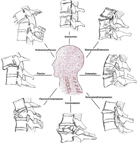 Subaxial Cervical Spine Injury Classification