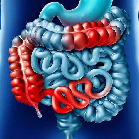 Болезнь Крона - симптомы и лечение Картинка - Болезнь Крона - симптомы и лечение