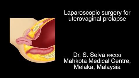 Laparoscopic Surgery For Uterovaginal Prolapse Youtube