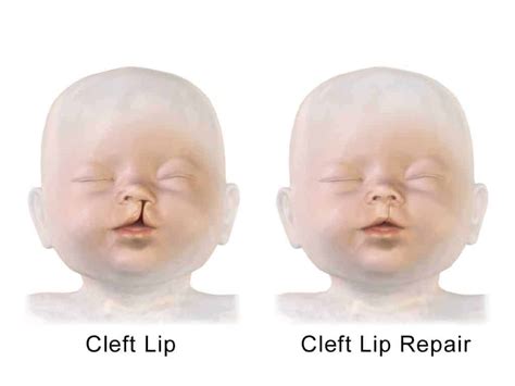 Cleft Lip And Palate Causes Symptoms Treatment Prognosis Costamedic