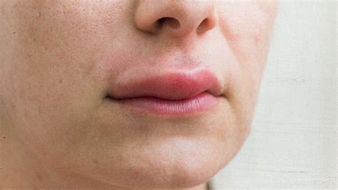 Top 8 Why Is My Lip Swollen 2022