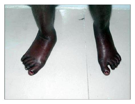 It Shows The Legs Of The Patient Exhibiting Shiny And Dry Skin