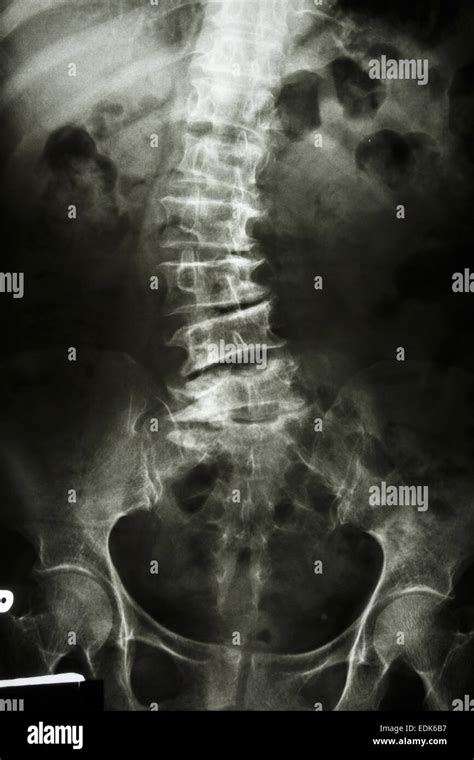 Scoliosis Film X Ray Lumbar Spine Ap Show Spine Bend In Old Aged