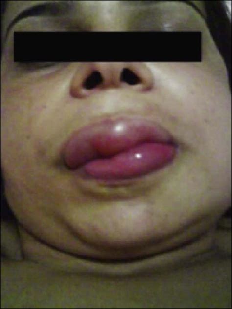 A rare type of hereditary angioedema (hereditary angioedema type 3) is characterized by normal c1 inhibitor levels. Hereditary angioedema type III (estrogen-dependent) report of three cases and literature review*