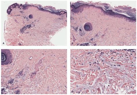 Vasculopathic Vasculitic And Neutrophilic Dermatosis Plastic