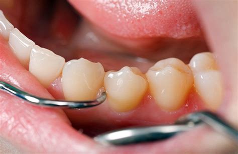 Curetaje Dental ¿qué Es Y Cómo Se Realiza Directorio Odontológico