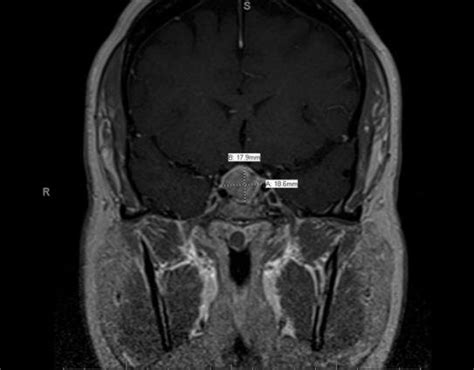 Pituitary Mri A Coronal T1 Post Contrast And B Sagittal T1