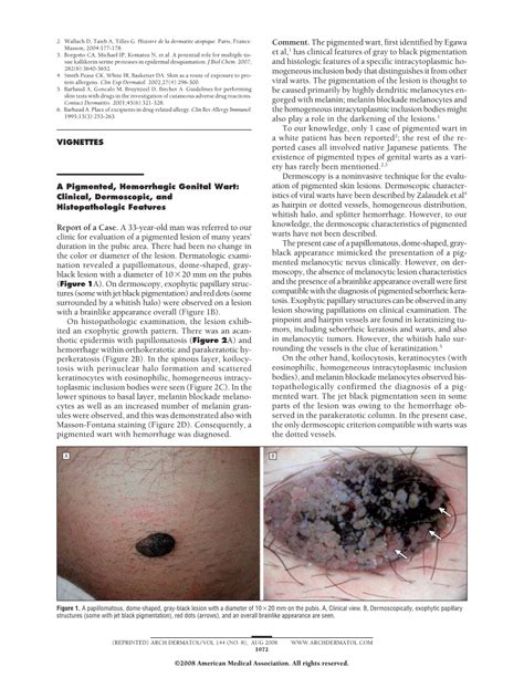 A Pigmented Hemorrhagic Genital Wart Clinical Dermoscopic And
