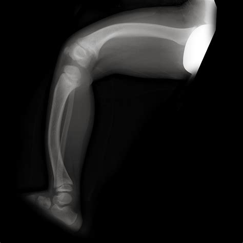 Sifats Disease Atlas Rickets