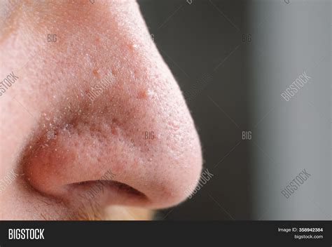 Clogged Pores Image And Photo Free Trial Bigstock