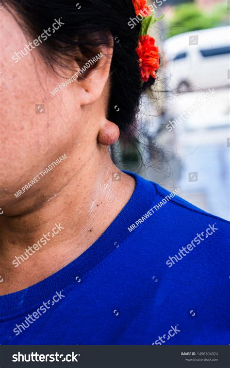 Sebaceous Cyst On Neck Woman Form Foto Stock Editar Agora 1456304924