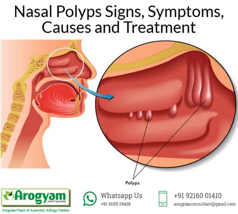 This Will Help You Understand What Nasal Polyps Are And What Are The