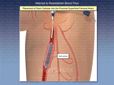 Placement Of Stent Catheter Into The Proximal Superficial Femoral Artery Trialexhibits Inc