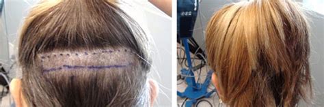 We always do what's best for the patient. Los Angeles FUE Hair Transplant | Dr. Sean Behnam