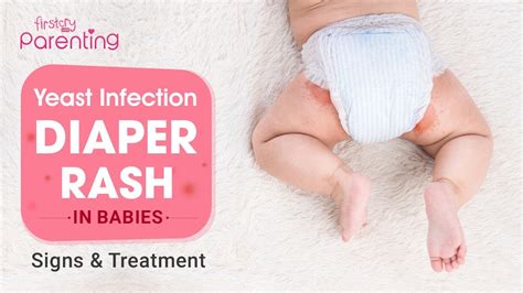 Yeast Infection Diaper Rash In Babies Causes And Remedies Youtube