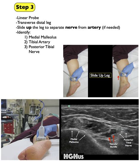 Posterior Tibial Tendon Ultrasound