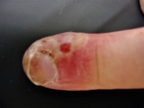 Herpes Virus Gives Man A Blistery Finger Infection Live Science