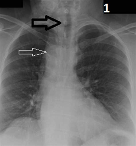 Chest X Ray Posterior Anterior View Prominent Right Aortic Arch Raa